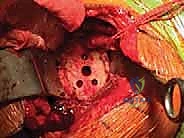 Surgical technique step for Hemiarthroplasty Total Shoulder Arthroplasty and Biologic Glenoid Resurfacing for Glenohumeral Arthritis With an Intact Rotator Cuff