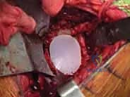 TECH FIG 8 A center pilot hole is drilled in the glenoid surface A and a spherical reamer is used to create a concentric surface B