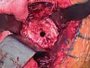 TECH FIG 8 A center pilot hole is drilled in the glenoid surface A and a spherical reamer is used to create a concentric surface B