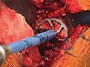 TECH FIG 8 A center pilot hole is drilled in the glenoid surface A and a spherical reamer is used to create a concentric surface B