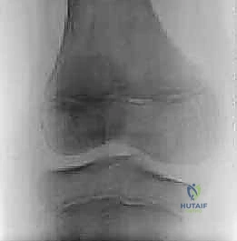 صورة توضيحية لـ جراحة الغضروف الهلالي القرصي الجانبي بالمنظار: دليلك الشامل للتشخيص والعلاج والتعافي مع الأستاذ الدكتور محمد هطيف