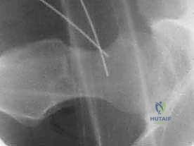 صورة توضيحية لـ انحشار الفخذ الحقي بالمنظار فهم شامل وعلاج متقدم للحفاظ على مفصل الورك مع الأستاذ الدكتور محمد هطيف