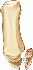 دليلك الشامل لكسور مفصل إبهام اليد الرسغي السنعي: التشخيص والعلاج مع الأستاذ الدكتور محمد هطيف