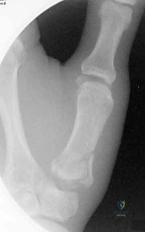 كسور خارج المفصل للإبهام