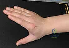 أعراض كسور مفصل الإبهام