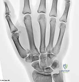 التصوير المقطعي لكسور اليد