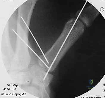 التثبيت الخارجي لكسور اليد