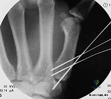 مقارنة خيارات العلاج لكسور الإبهام