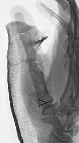 صورة توضيحية لـ دليلك الشامل لكسور مفصل إبهام اليد الرسغي السنعي: التشخيص والعلاج مع الأستاذ الدكتور محمد هطيف