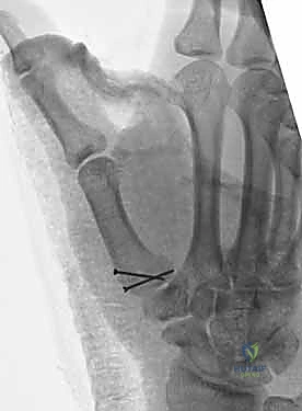 صورة توضيحية لـ دليلك الشامل لكسور مفصل إبهام اليد الرسغي السنعي: التشخيص والعلاج مع الأستاذ الدكتور محمد هطيف