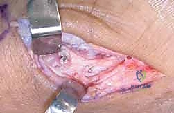 صورة توضيحية لـ دليلك الشامل لكسور مفصل إبهام اليد الرسغي السنعي: التشخيص والعلاج مع الأستاذ الدكتور محمد هطيف