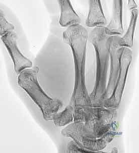 صورة توضيحية لـ دليلك الشامل لكسور مفصل إبهام اليد الرسغي السنعي: التشخيص والعلاج مع الأستاذ الدكتور محمد هطيف