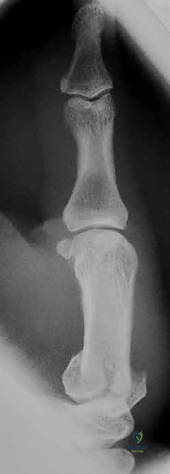 صورة طبية: دليلك الشامل لكسور مفصل إبهام اليد الرسغي السنعي: التشخيص والعلاج مع الأستاذ الدكتور محمد هطيف