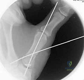 صورة طبية: دليلك الشامل لكسور مفصل إبهام اليد الرسغي السنعي: التشخيص والعلاج مع الأستاذ الدكتور محمد هطيف