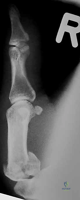 صورة طبية: دليلك الشامل لكسور مفصل إبهام اليد الرسغي السنعي: التشخيص والعلاج مع الأستاذ الدكتور محمد هطيف