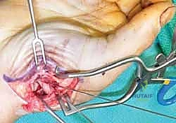 صورة طبية: دليلك الشامل لكسور مفصل إبهام اليد الرسغي السنعي: التشخيص والعلاج مع الأستاذ الدكتور محمد هطيف