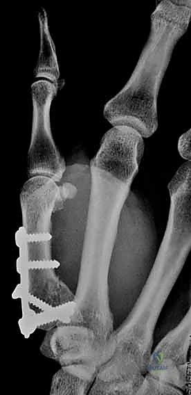 صورة طبية: دليلك الشامل لكسور مفصل إبهام اليد الرسغي السنعي: التشخيص والعلاج مع الأستاذ الدكتور محمد هطيف