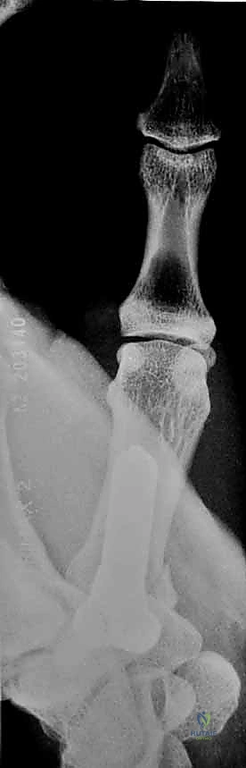 صورة توضيحية لـ دليلك الشامل لكسور مفصل إبهام اليد الرسغي السنعي: التشخيص والعلاج مع الأستاذ الدكتور محمد هطيف