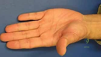 صورة طبية: دليلك الشامل لكسور مفصل إبهام اليد الرسغي السنعي: التشخيص والعلاج مع الأستاذ الدكتور محمد هطيف