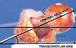أسباب زيادة الانحراف الأمامي لعظم الفخذ