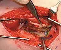 تحديد مكان القطع العظمي في الفخذ