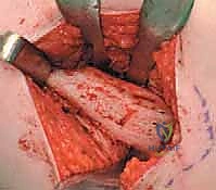 خيارات العلاج التحفظي والجراحي