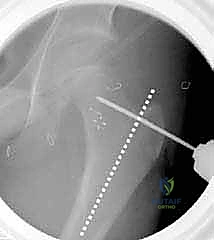 تدوير عظم الفخذ للزاوية الصحيحة