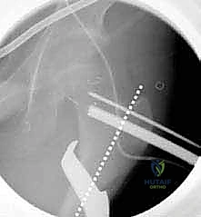 تثبيت العظم باستخدام صفيحة AO