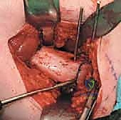 صورة توضيحية لـ قطع عظم الفخذ الدوراني القريب لتصحيح الانحراف الأمامي: خبرة الأستاذ الدكتور محمد هطيف