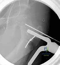 وضعية الجلوس على شكل حرف W