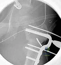 صورة توضيحية لـ قطع عظم الفخذ الدوراني القريب لتصحيح الانحراف الأمامي: خبرة الأستاذ الدكتور محمد هطيف