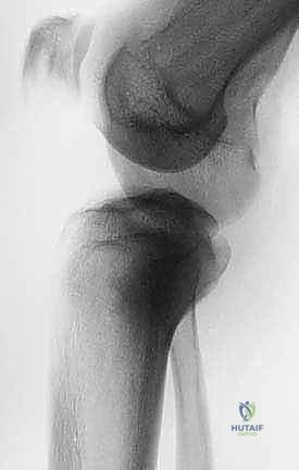 ورم الخلايا العملاقة