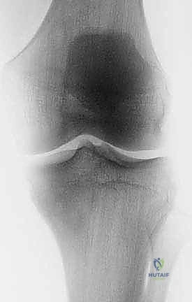 صورة توضيحية لورم عظمي