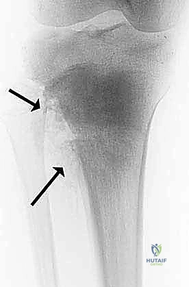 أورام نقائلية في العظم