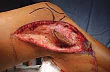 صورة توضيحية لـ استئصال الجزء القريب من عظم الساق (الظنبوب) وإعادة البناء بالطرف الصناعي: دليل شامل للمرضى