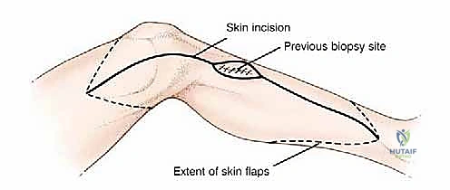 صورة توضيحية لـ استئصال الجزء القريب من عظم الساق (الظنبوب) وإعادة البناء بالطرف الصناعي: دليل شامل للمرضى