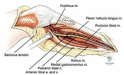 صورة طبية: استئصال الجزء القريب من عظم الساق (الظنبوب) وإعادة البناء بالطرف الصناعي: دليل شامل للمرضى