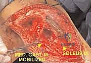 صورة طبية: استئصال الجزء القريب من عظم الساق (الظنبوب) وإعادة البناء بالطرف الصناعي: دليل شامل للمرضى