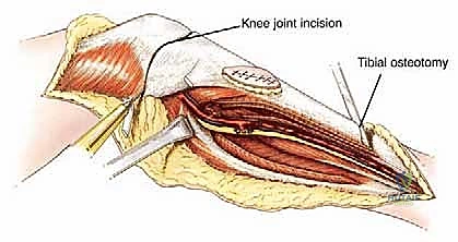 صورة طبية: استئصال الجزء القريب من عظم الساق (الظنبوب) وإعادة البناء بالطرف الصناعي: دليل شامل للمرضى