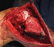 صورة طبية: استئصال الجزء القريب من عظم الساق (الظنبوب) وإعادة البناء بالطرف الصناعي: دليل شامل للمرضى