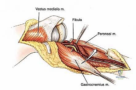 صورة طبية: استئصال الجزء القريب من عظم الساق (الظنبوب) وإعادة البناء بالطرف الصناعي: دليل شامل للمرضى