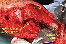 صورة طبية: استئصال الجزء القريب من عظم الساق (الظنبوب) وإعادة البناء بالطرف الصناعي: دليل شامل للمرضى