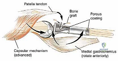 صورة طبية: استئصال الجزء القريب من عظم الساق (الظنبوب) وإعادة البناء بالطرف الصناعي: دليل شامل للمرضى