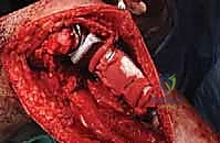 صورة طبية: استئصال الجزء القريب من عظم الساق (الظنبوب) وإعادة البناء بالطرف الصناعي: دليل شامل للمرضى