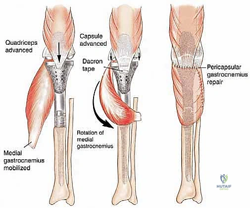 صورة طبية: استئصال الجزء القريب من عظم الساق (الظنبوب) وإعادة البناء بالطرف الصناعي: دليل شامل للمرضى