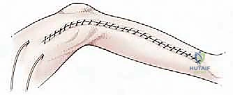 صورة طبية: استئصال الجزء القريب من عظم الساق (الظنبوب) وإعادة البناء بالطرف الصناعي: دليل شامل للمرضى