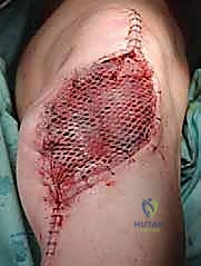 صورة طبية: استئصال الجزء القريب من عظم الساق (الظنبوب) وإعادة البناء بالطرف الصناعي: دليل شامل للمرضى