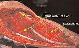 صورة طبية: استئصال الجزء القريب من عظم الساق (الظنبوب) وإعادة البناء بالطرف الصناعي: دليل شامل للمرضى