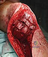 صورة طبية: استئصال الجزء القريب من عظم الساق (الظنبوب) وإعادة البناء بالطرف الصناعي: دليل شامل للمرضى