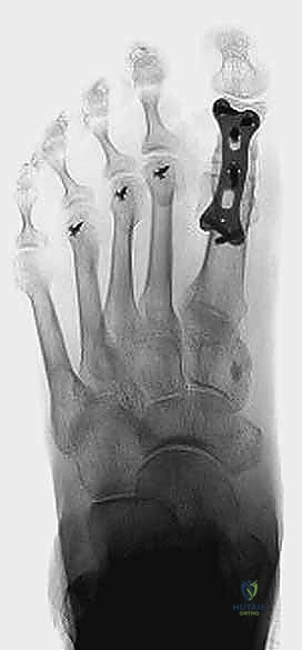 جراحة تثبيت مفصل إبهام القدم الكبير المراجعة: استعادة الوظيفة وتخفيف الألم مع الأستاذ الدكتور محمد هطيف